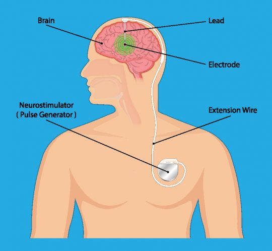 Deep Brain Stimulation