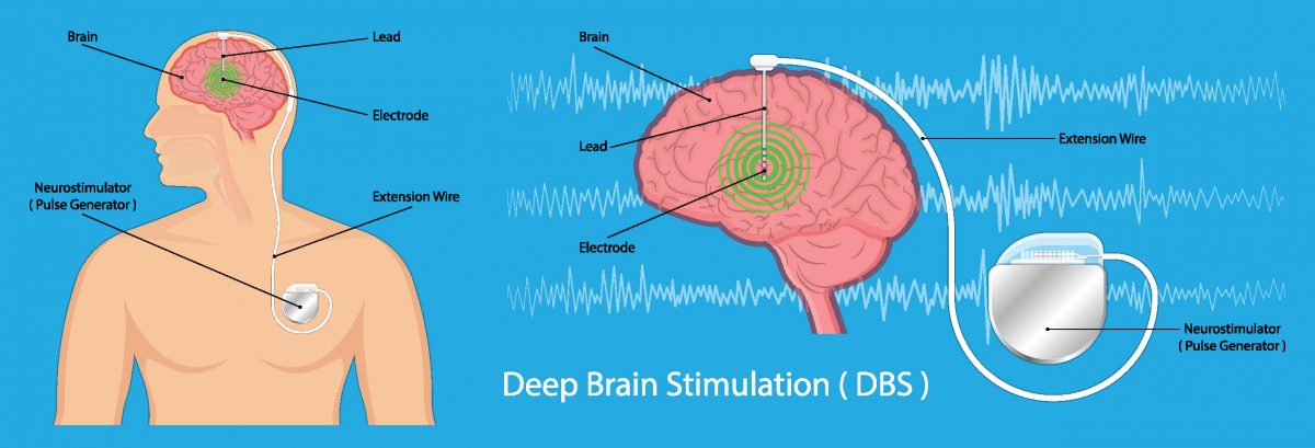 Deep Brain Stimulation: Relief from Movement Disorders - Michigan Head ...