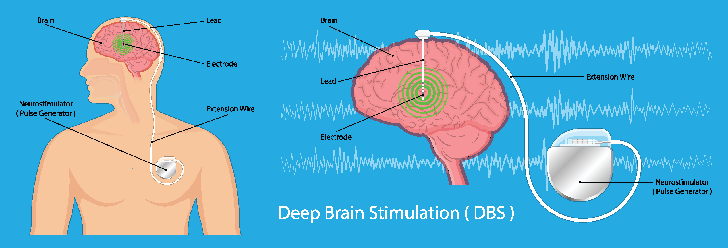 Deep-Brain Stimulation for Parkinson's Disease