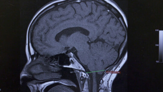 chiari malformation xray